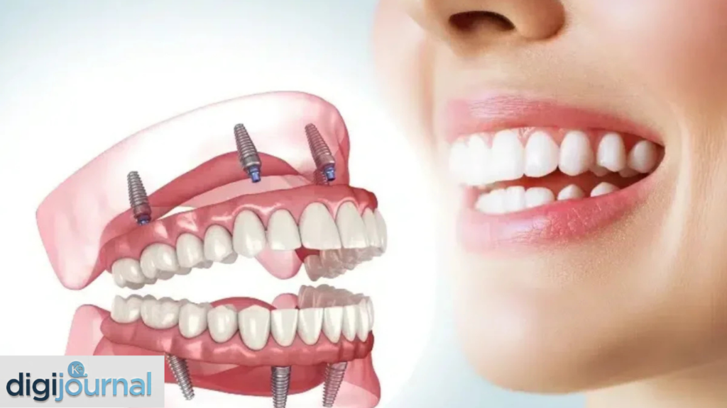 Dental Implants Cost